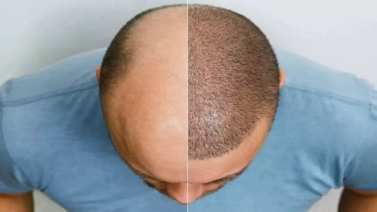 نجاحات متقدمة للثورة الروبوتية السعودية في علاج الصلع بنسبة 95% وشفاء خلال 3 أيام