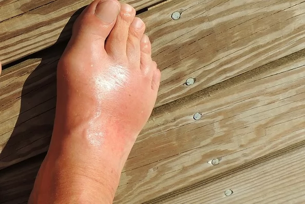 «احمِ صحتك من النقرس» أطعمة يجب تجنبها للحفاظ على مستويات حمض اليوريك تحت السيطرة