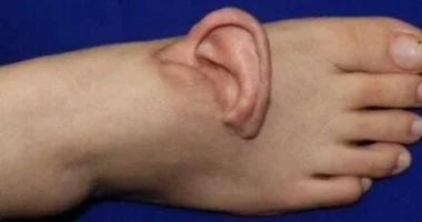 صينية تعيد تثبيت أذنها بعد 5 أشهر من نموها داخل قدمها