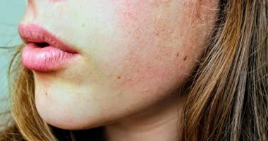 5 عادات يومية تدمر نضارة وجهك وتسبب المسام الواسعة توقفي عنها فوراً