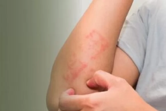 «وداعًا للحكة المنهكة!» نيموليزوماب: علاج بيولوجي واعد يقدّم بصيص أمل جديد لمرضى الإكزيما بتخفيف فوري للحكة