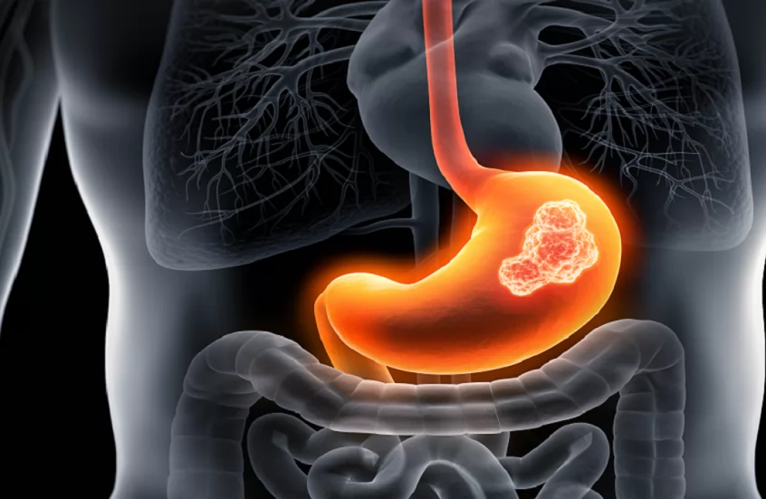 «إنذار عاجل!» عادة يومية خفية تهدد بسرطان المعدة: هل تمارسها دون أن تدري؟