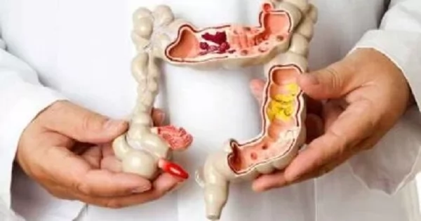 «خارج التوقعات… اكتشاف يُشعل آمالاً جديدة!» طفرة بكتيرية غير متوقعة تفتح آفاقاً واعدة لعلاج سرطان القولون