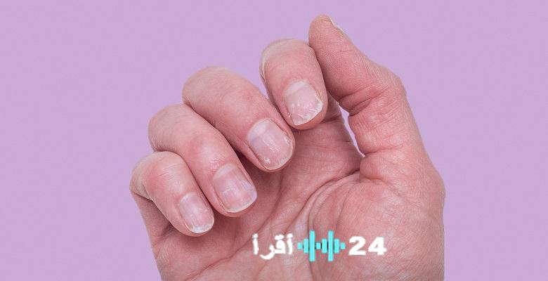 «وداعًا للتكسر».. الأسباب الحقيقية وراء هشاشة الأظافر وأفضل البروتوكولات العلاجية لاستعادة قوتها ولمعانها