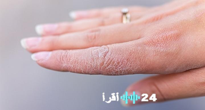 «لغز يُحير الجميع» لماذا يستمر تقشر الجلد رغم الترطيب المكثف؟ إليك الأسباب الخفية وروشتة العلاج لإنهاء المعاناة فورًا