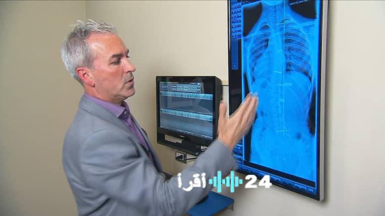 الجنف عند المراهقين ظاهرة شائعة وتحذيرات طبية من تفاقم الانحناء في حال عدم العلاج