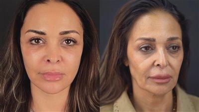 داليا البحيري على خطى غادة عادل تجري شد الوجه لتوديع مظهر الإرهاق