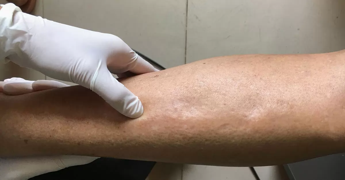 «السر وراء الانتفاخ: اكتشف ما يخفيه جسمك!» فك شيفرة الجسم: الأسباب الخفية وراء ظاهرة احتباس الماء وتأثيراتها الصامتة