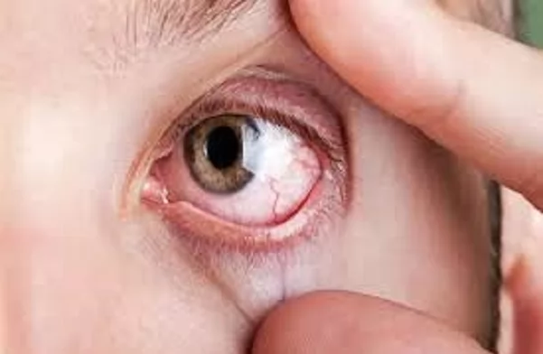 «حين يكشف المجهر أسرار الخطر.» ميلانوما العين: قراءة معمقة في الأعراض النادرة والتهديد الصامت للرؤية