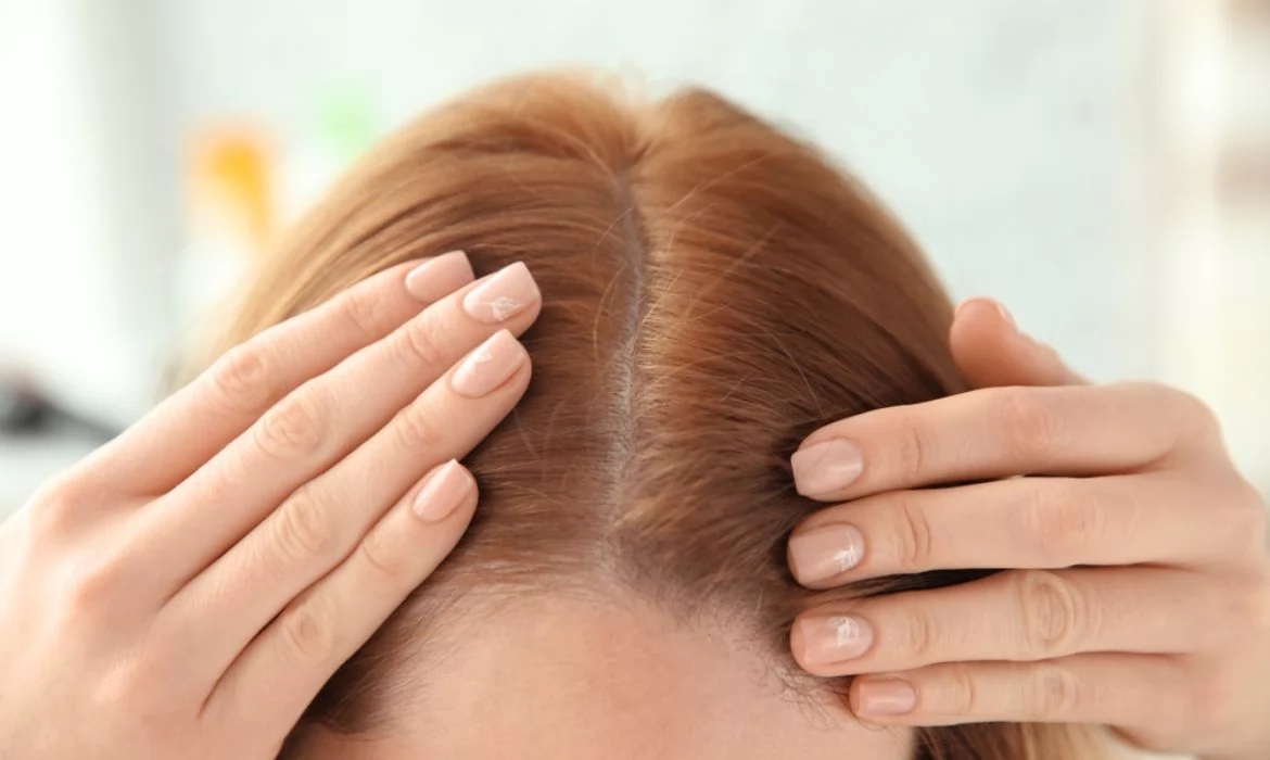 «حلولك بين يديك» اكتشف أقوى الطرق الطبيعية للتخلص من قشرة الرأس واستعادة صحة شعرك