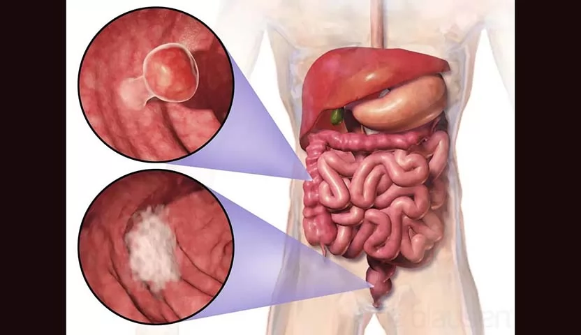 «وعيك يبدأ هنا» علامات سرطان القولون والمستقيم: دليل إرشادي لا يمكن إغفاله