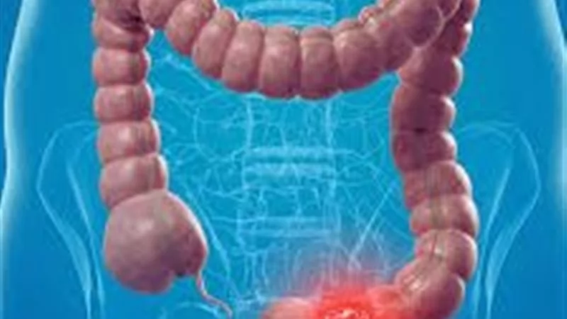 «لحياة آمنة» علامات سرطان القولون المبكرة: تحذيرات جسدك لا يجوز تجاهلها